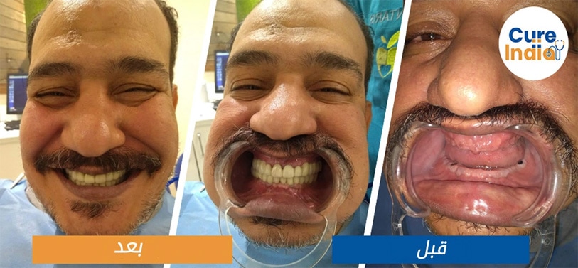 ما هي مزايا الكل في 6 زراعة الأسنان